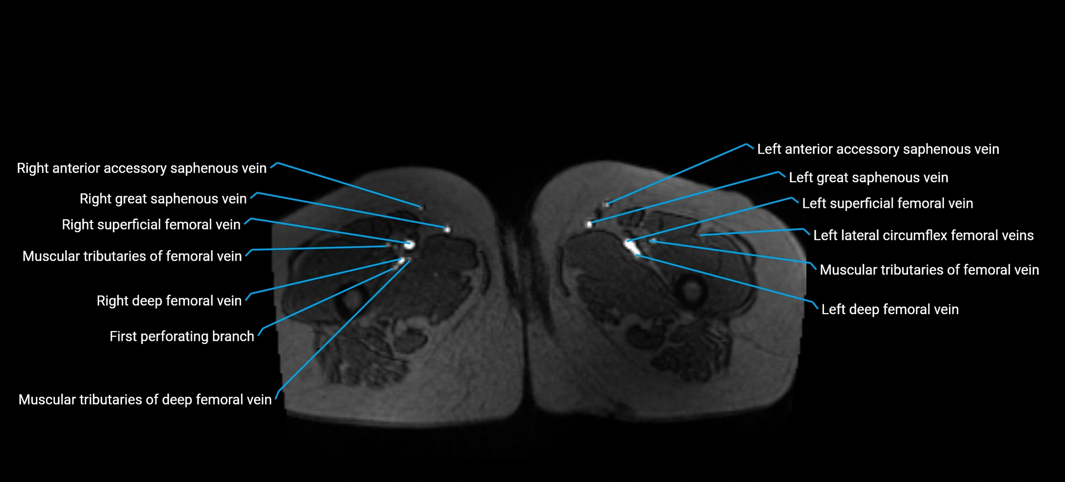 MRV abdomen pelvis & lower limb axial cross sectional anatomy labelled MRI image 219 (1).webp
